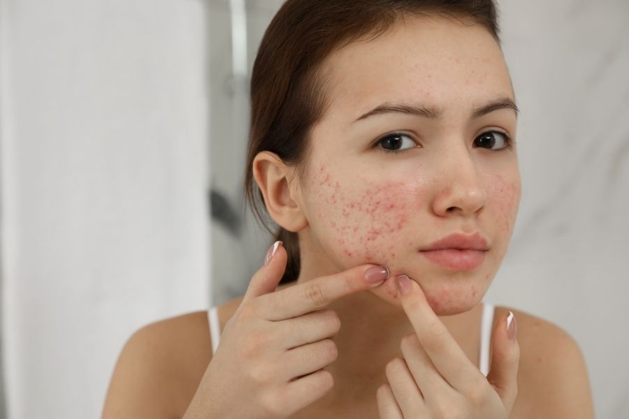 Woman examining adult acne breakouts on her face in bathroom mirror